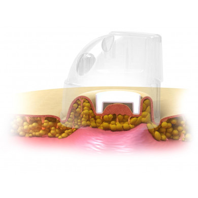 Вакуумно-роликовый аппарат &quot;DX SMART&quot;